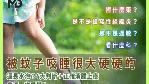 被蚊子咬腫很大硬硬的還長水泡？4大判斷＋正確消腫止癢處理一次看懂！