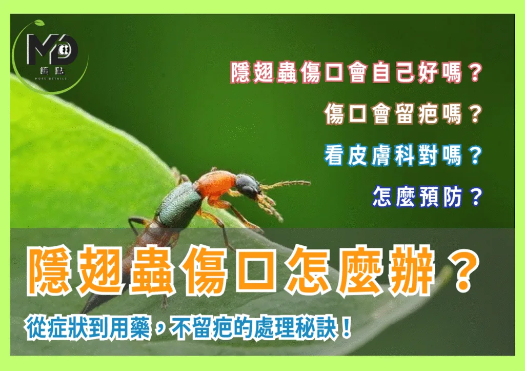 隱翅蟲傷口怎麼辦?從症狀到用藥,不留疤的處理秘訣!